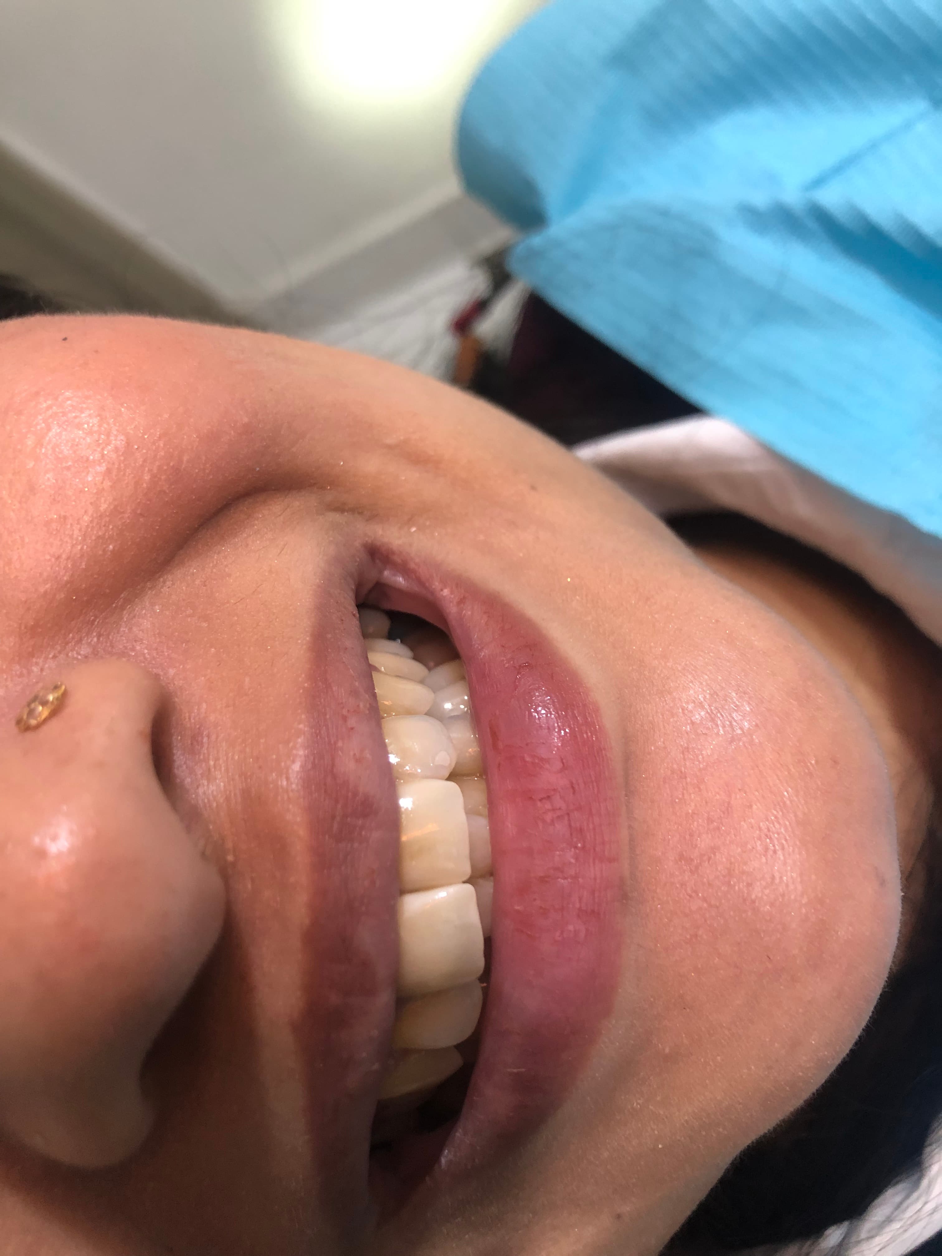 Crowns & Bridges before and after dental case
