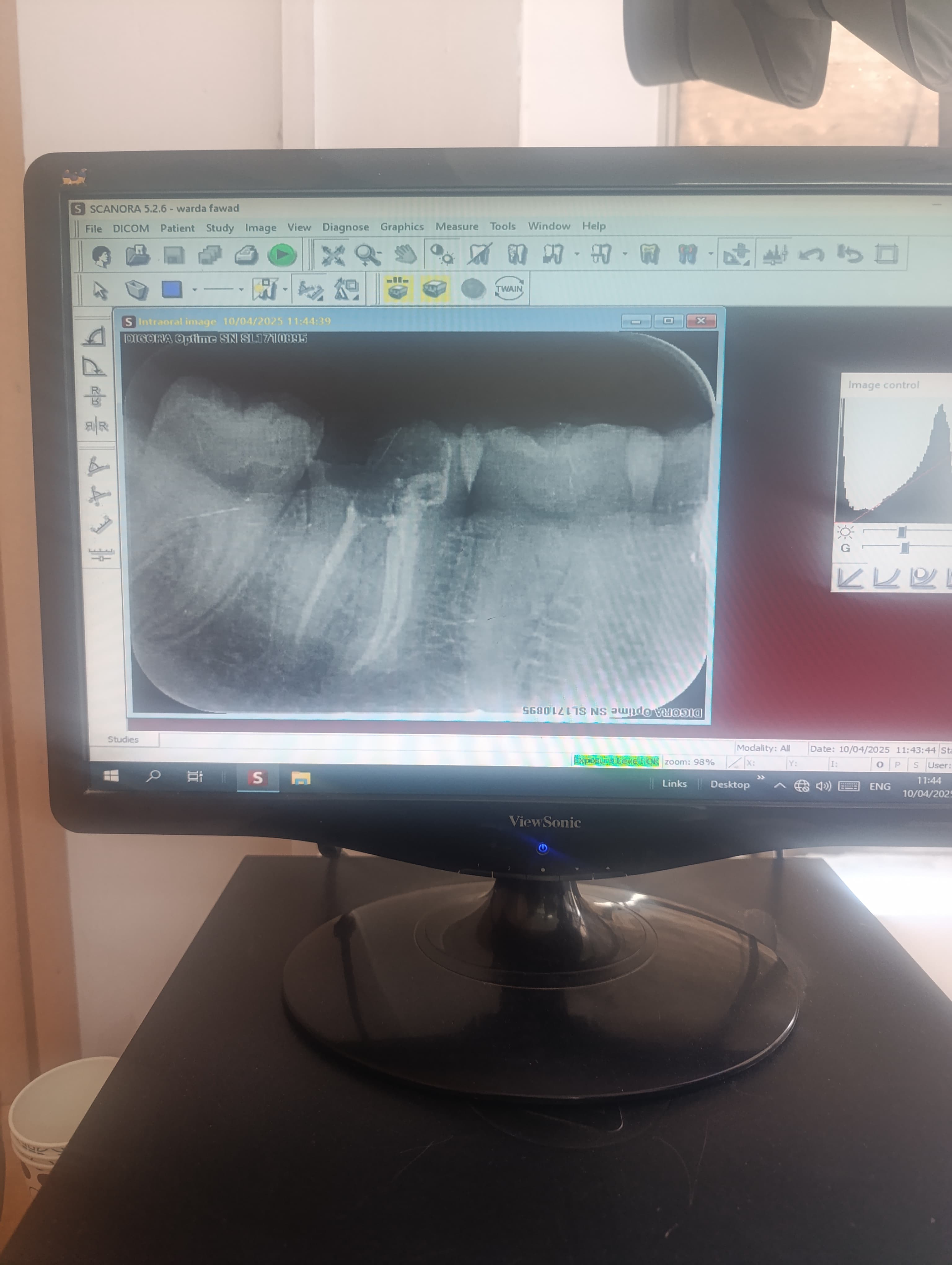Mr. Mubeen before — severe decay and pulpitis