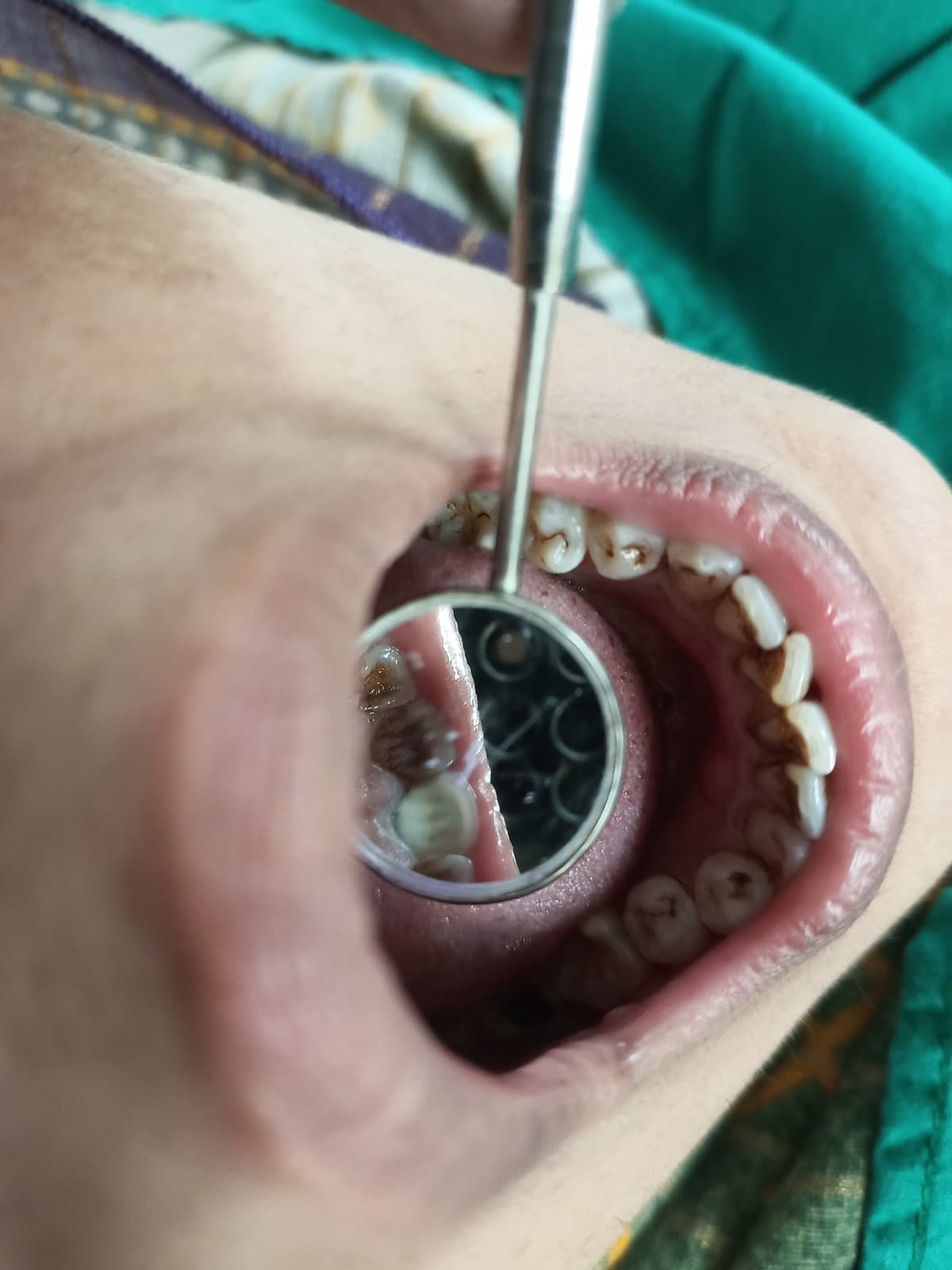 Scaling & Polishing before and after dental case