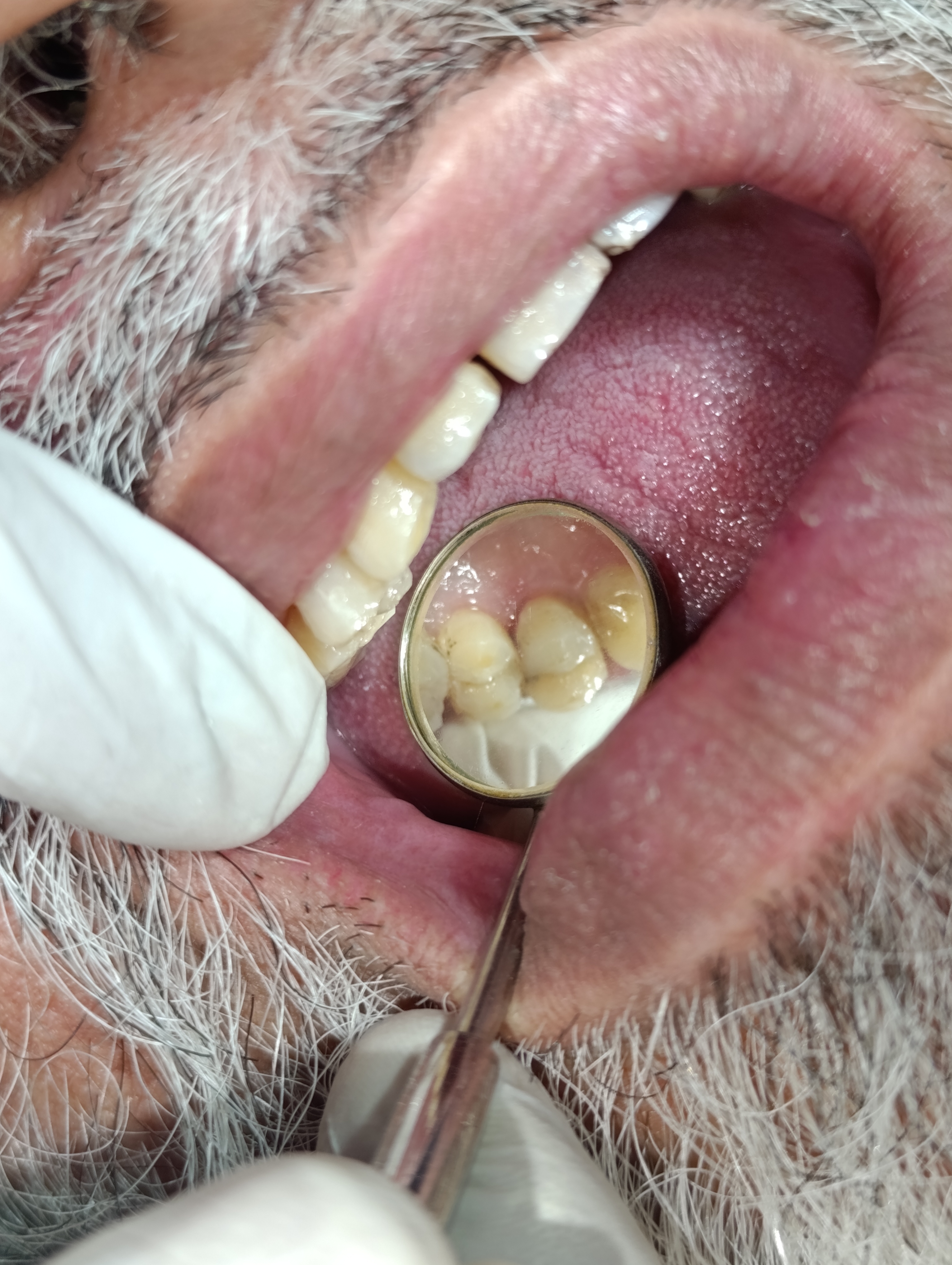 Qari Sultan Mahmood — Class II laser-assisted composite restoration