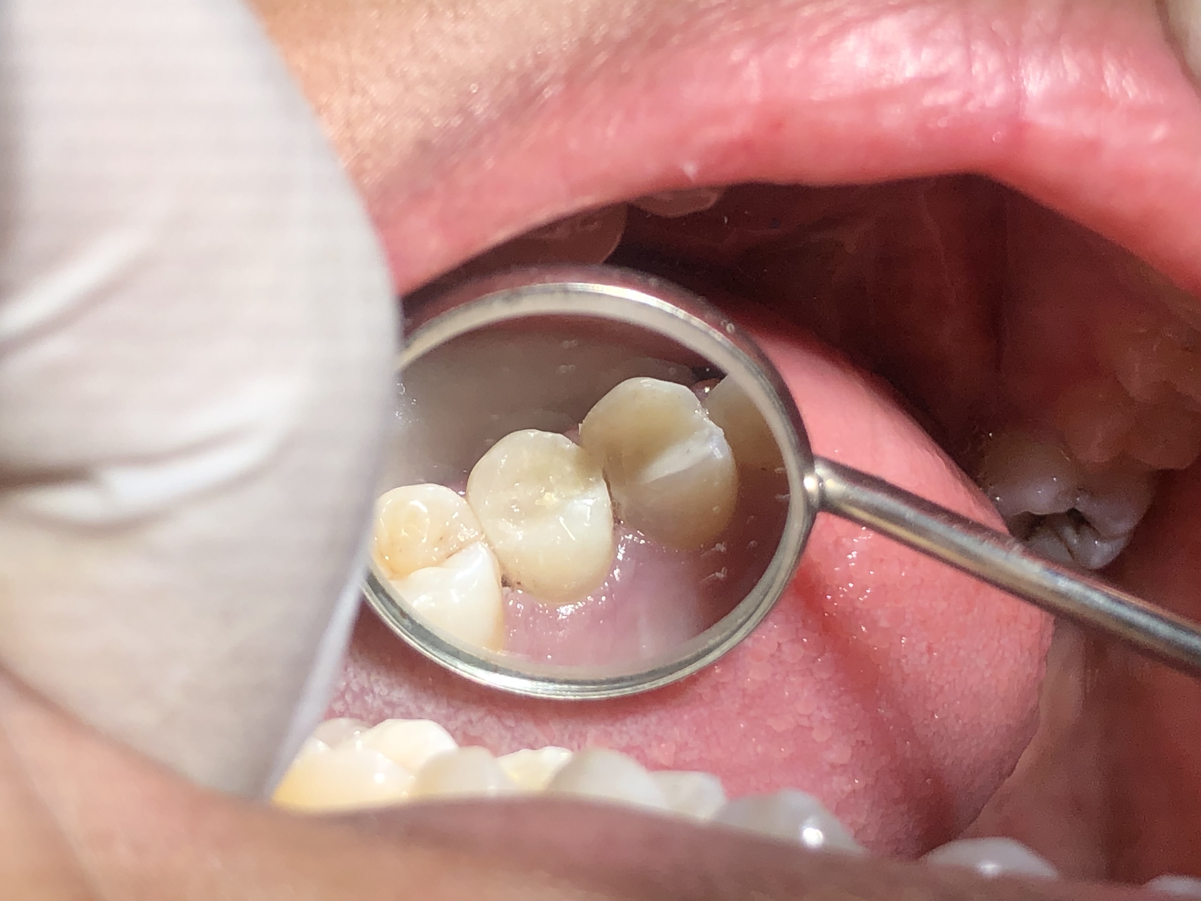 Ms. Warda — Bilateral Class II composite restorations