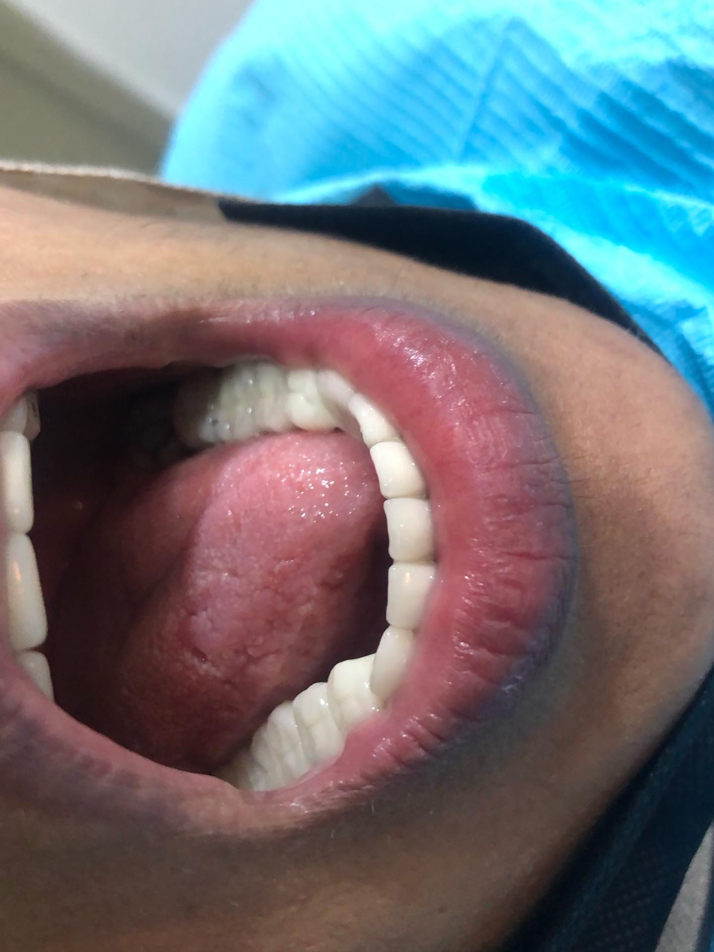 Pre-op view of Ms. Abida — old full-mouth bridge with visible marginal breakdown and gingival inflammation