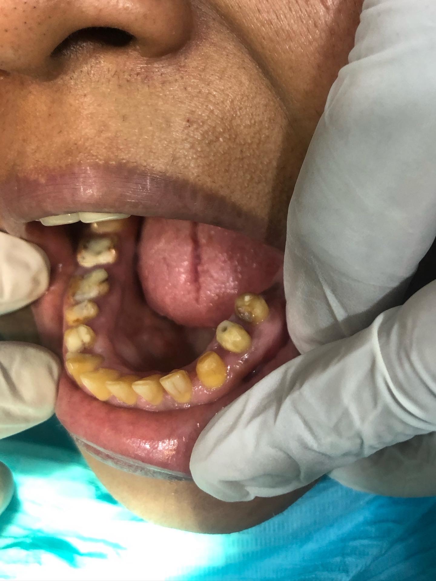 Ms. Abida Rashid — Full-mouth bridge revision + endodontics + perio