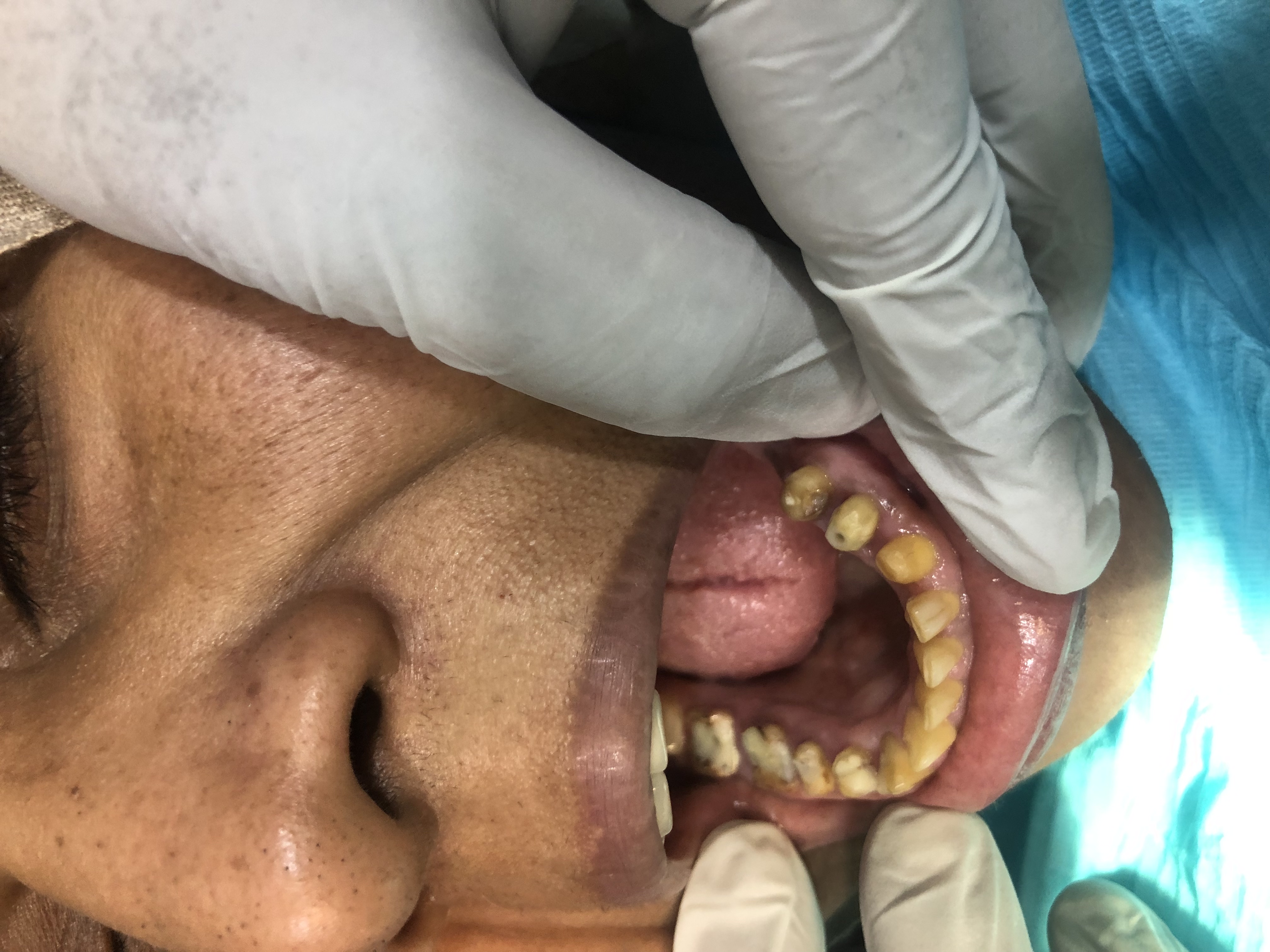 Six-month follow-up of Ms. Abida — bridge margins clean, gum healthy