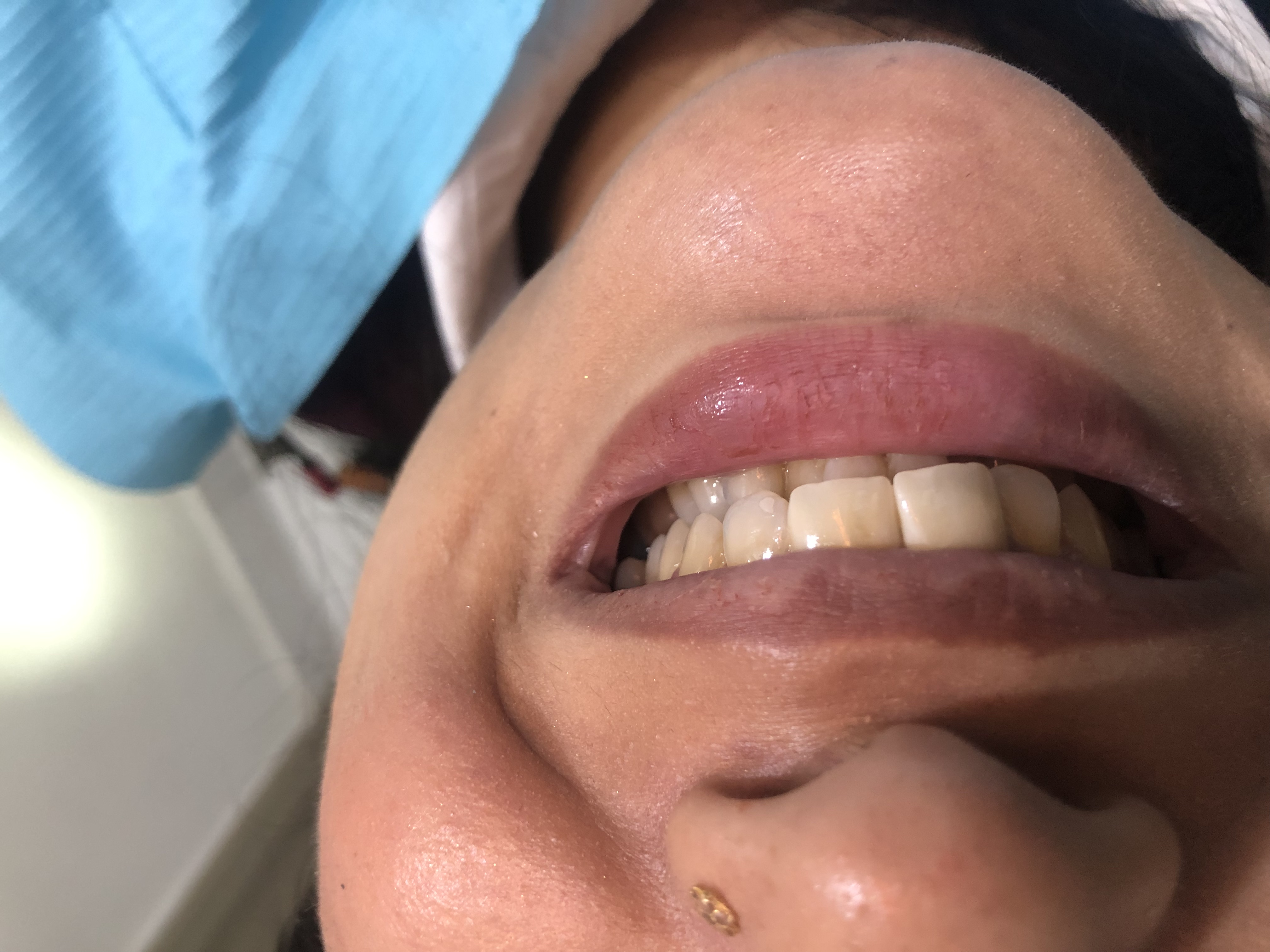 Ms. Ammarah — Zirconia crowns · upper central incisors