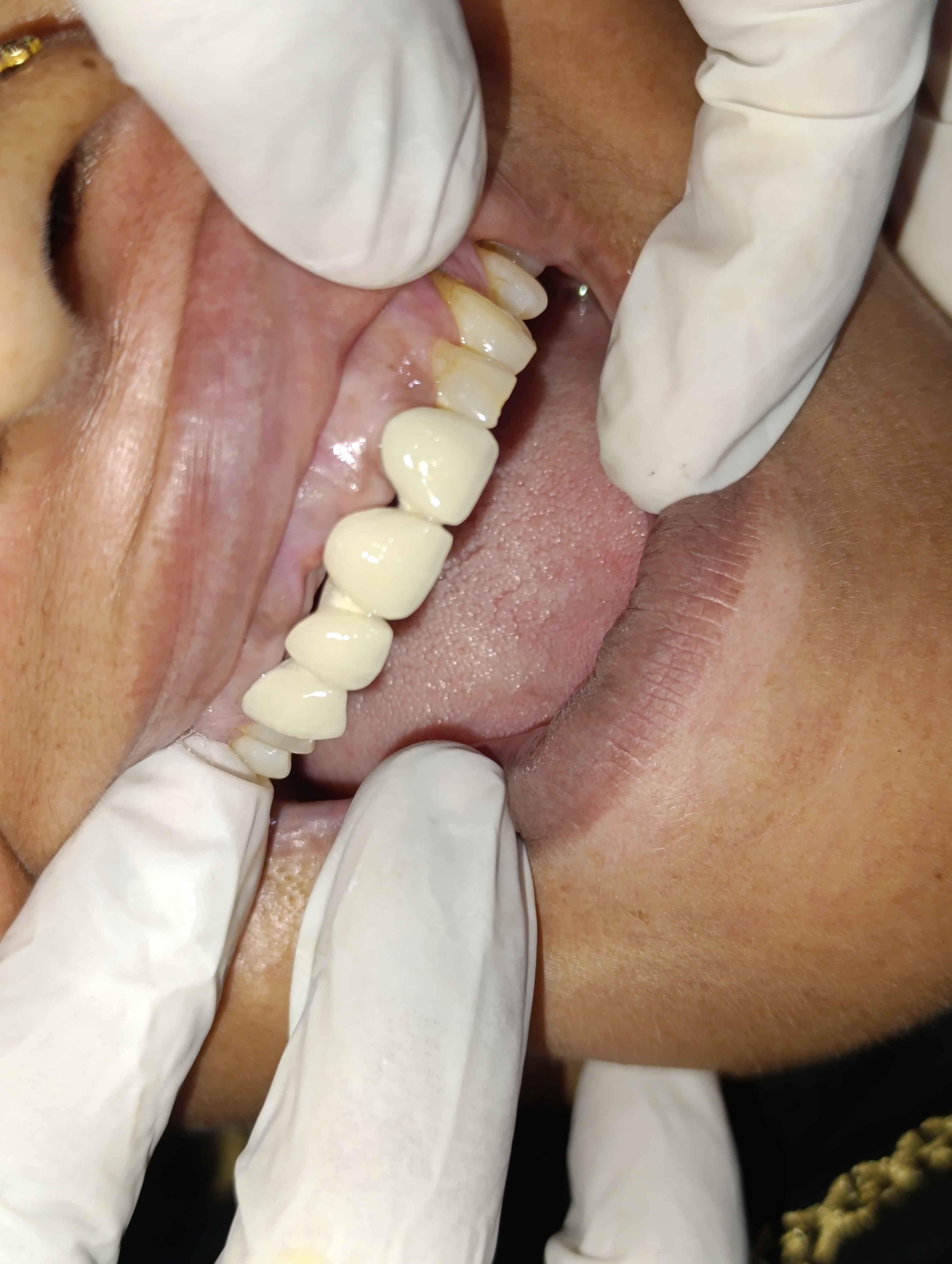 Ms. Khalida — PFM rehabilitation with artificial gingiva