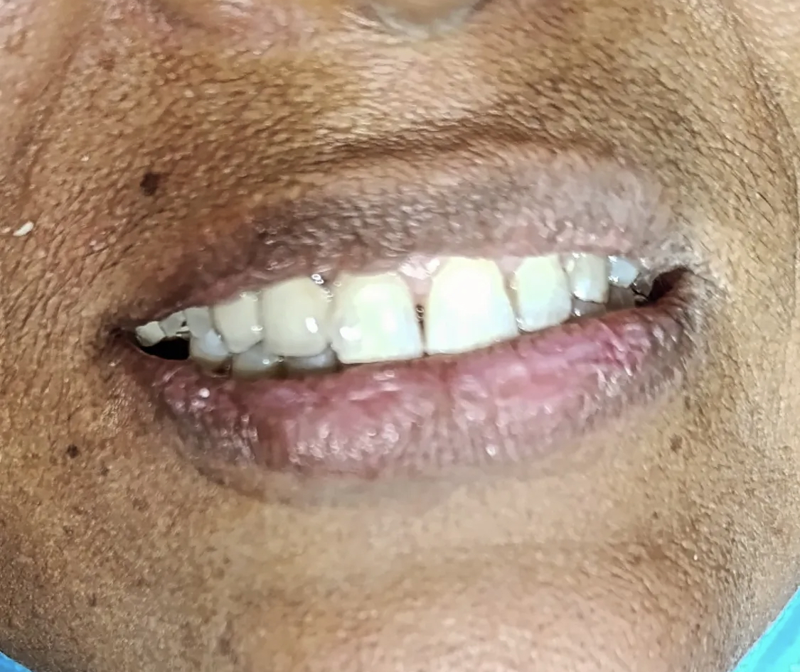 Ms. Parveen — Anterior PFM bridge · upper front teeth