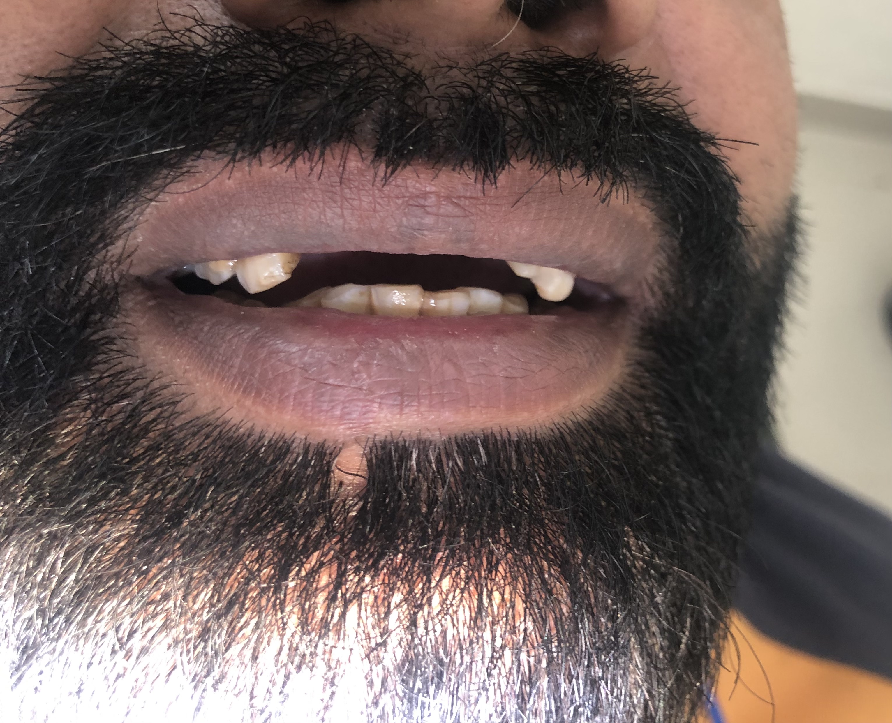 Mr. Sajid — Fixed PFM bridge · replaced failed removable
