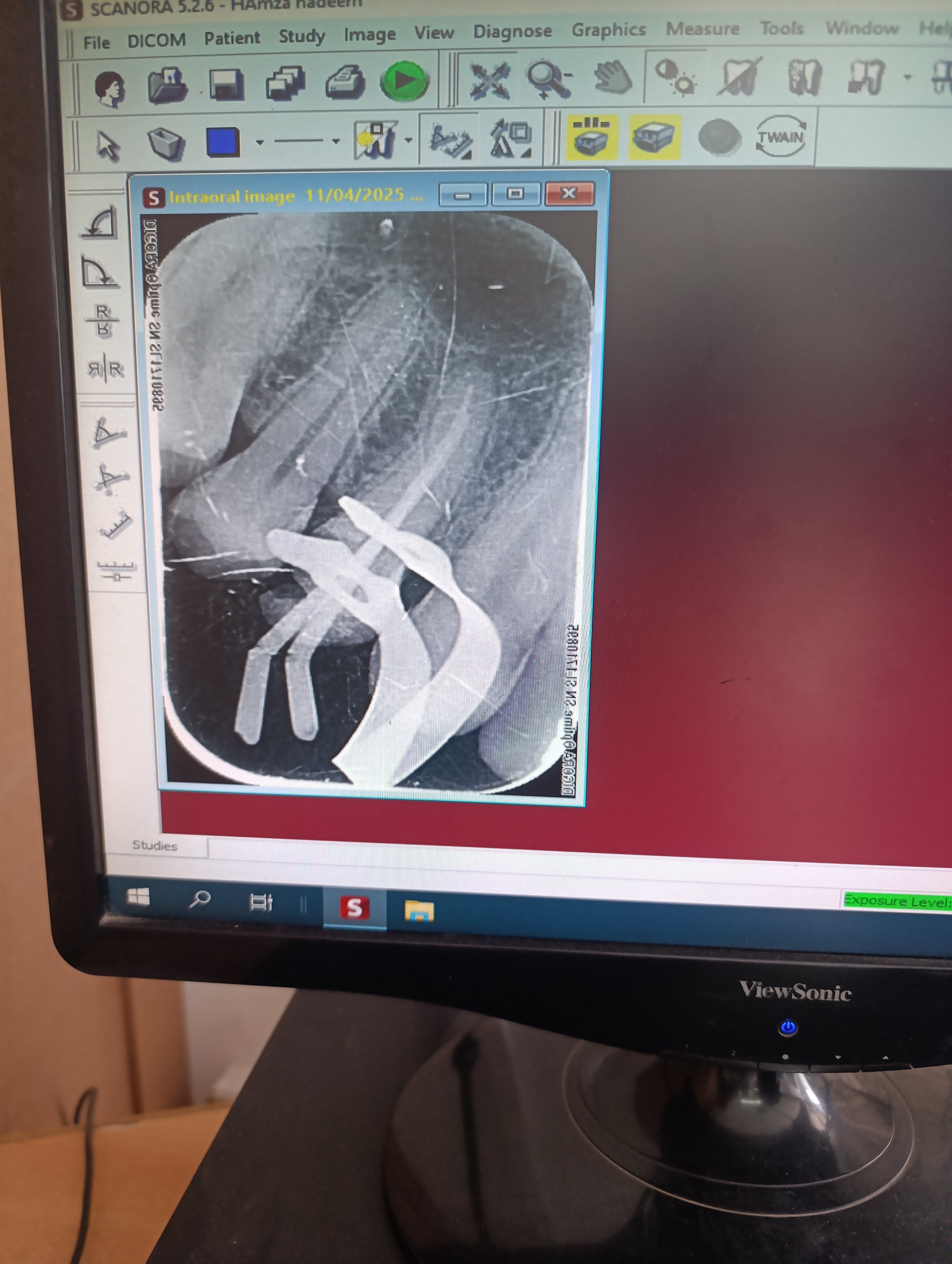Pre-operative radiograph showing peri-apical changes around tooth 14