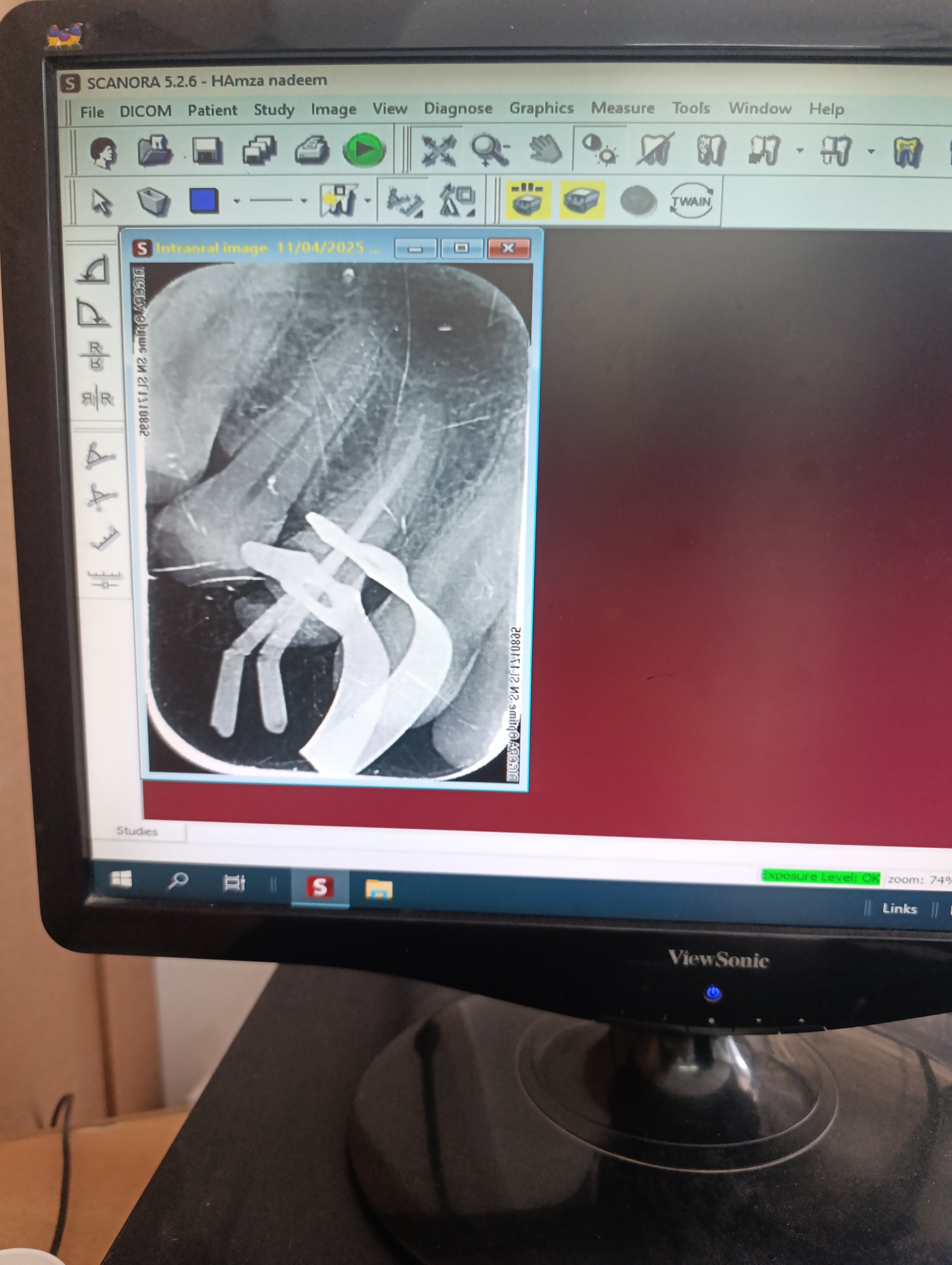 Mr. Aun — RCT · upper right first premolar (tooth 14)