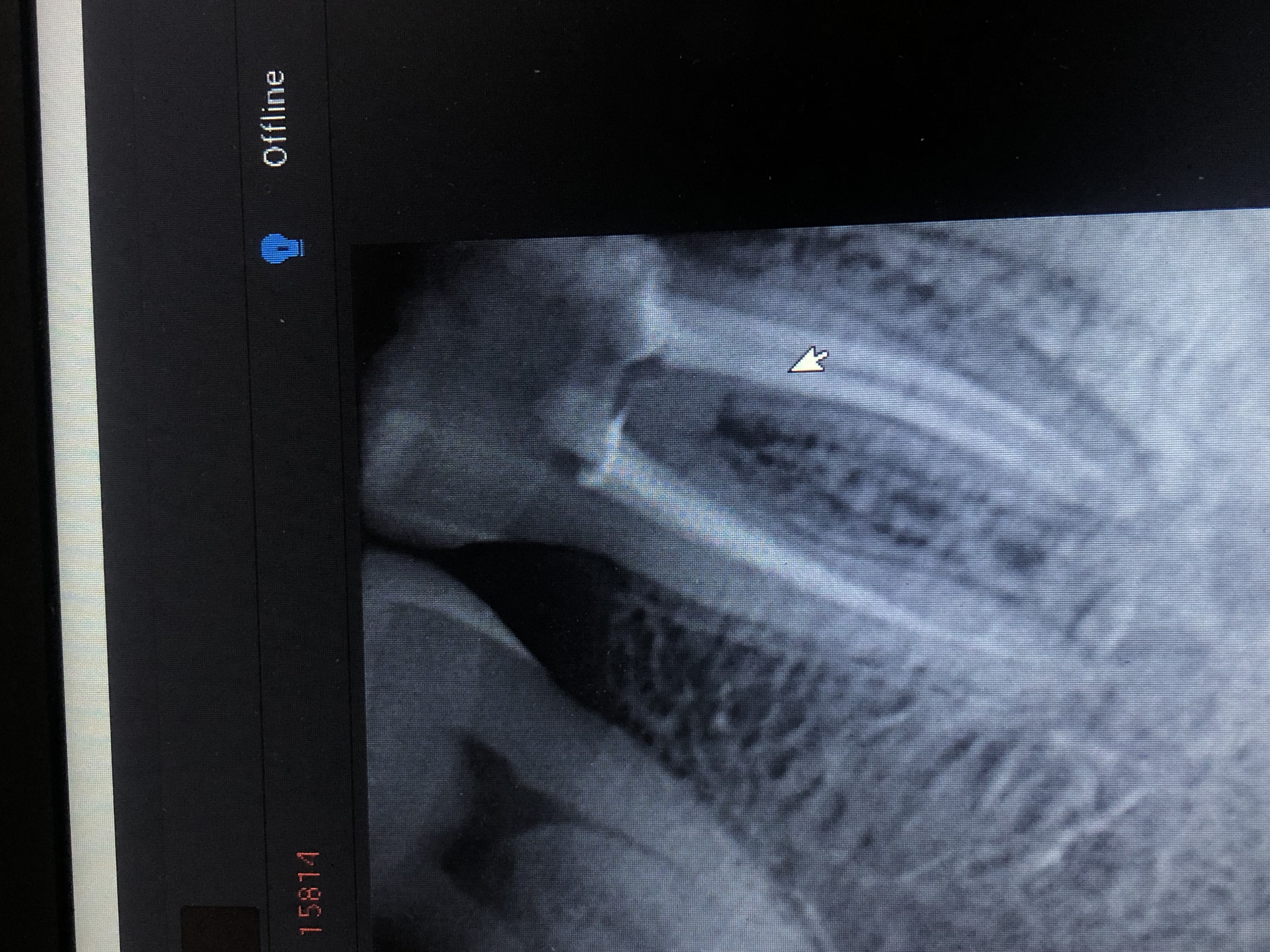 Mr. Ayaan — RCT · lower left first molar (tooth 36)