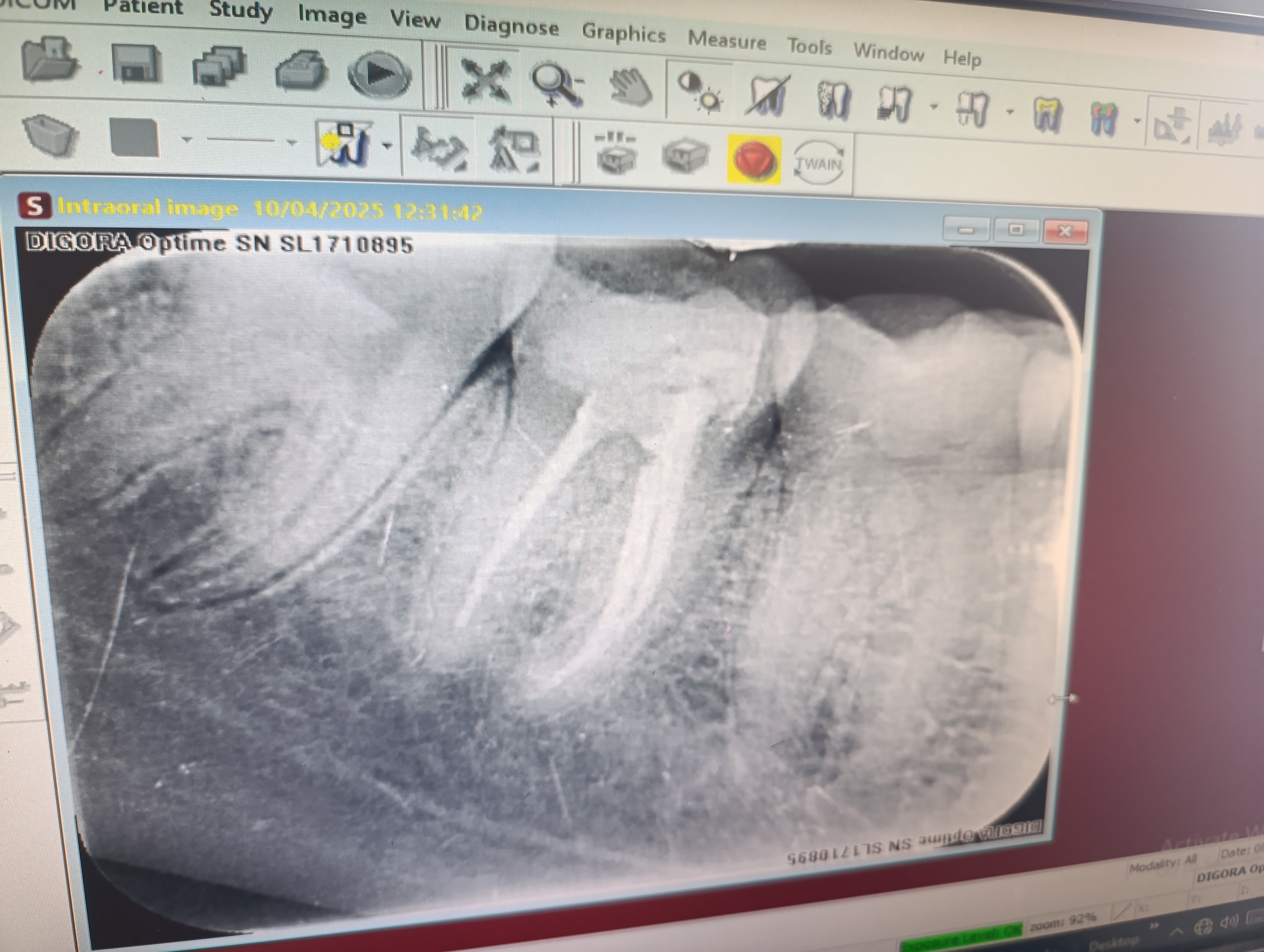 Mr. Mubeen — Single-visit RCT · lower-left posterior