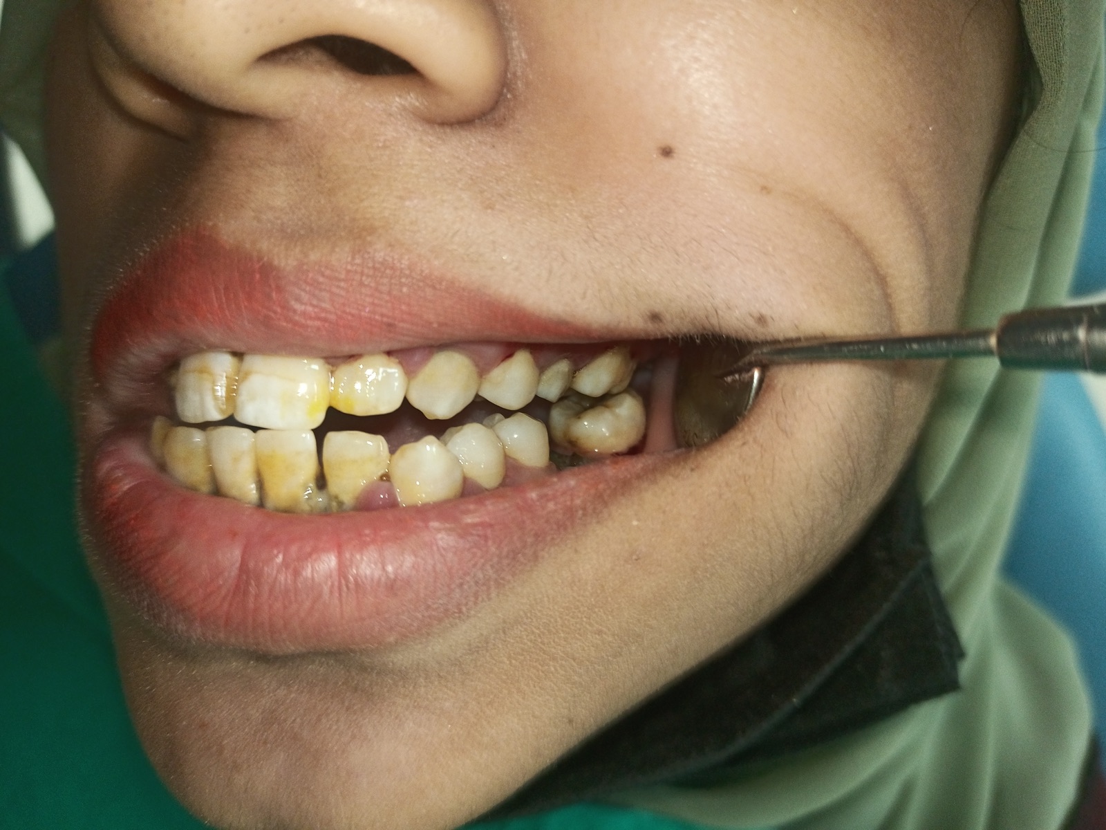 Lower-anterior close-up of Ms. Anam on day one — light brown band at the gum line