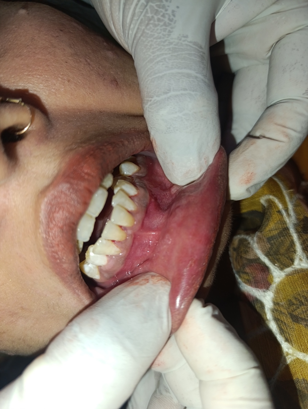 Ms. Bilqees — scaling and polishing case