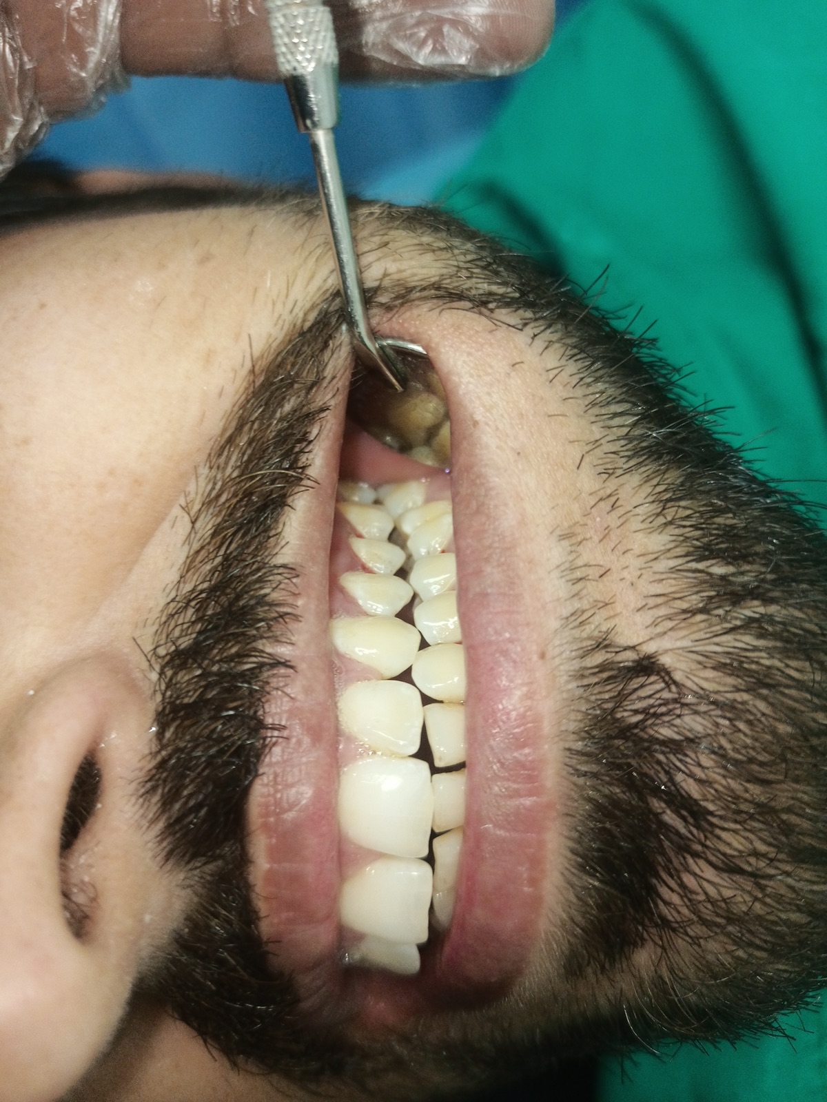 Mr. Imtiaz — Odonto Lahore patient story