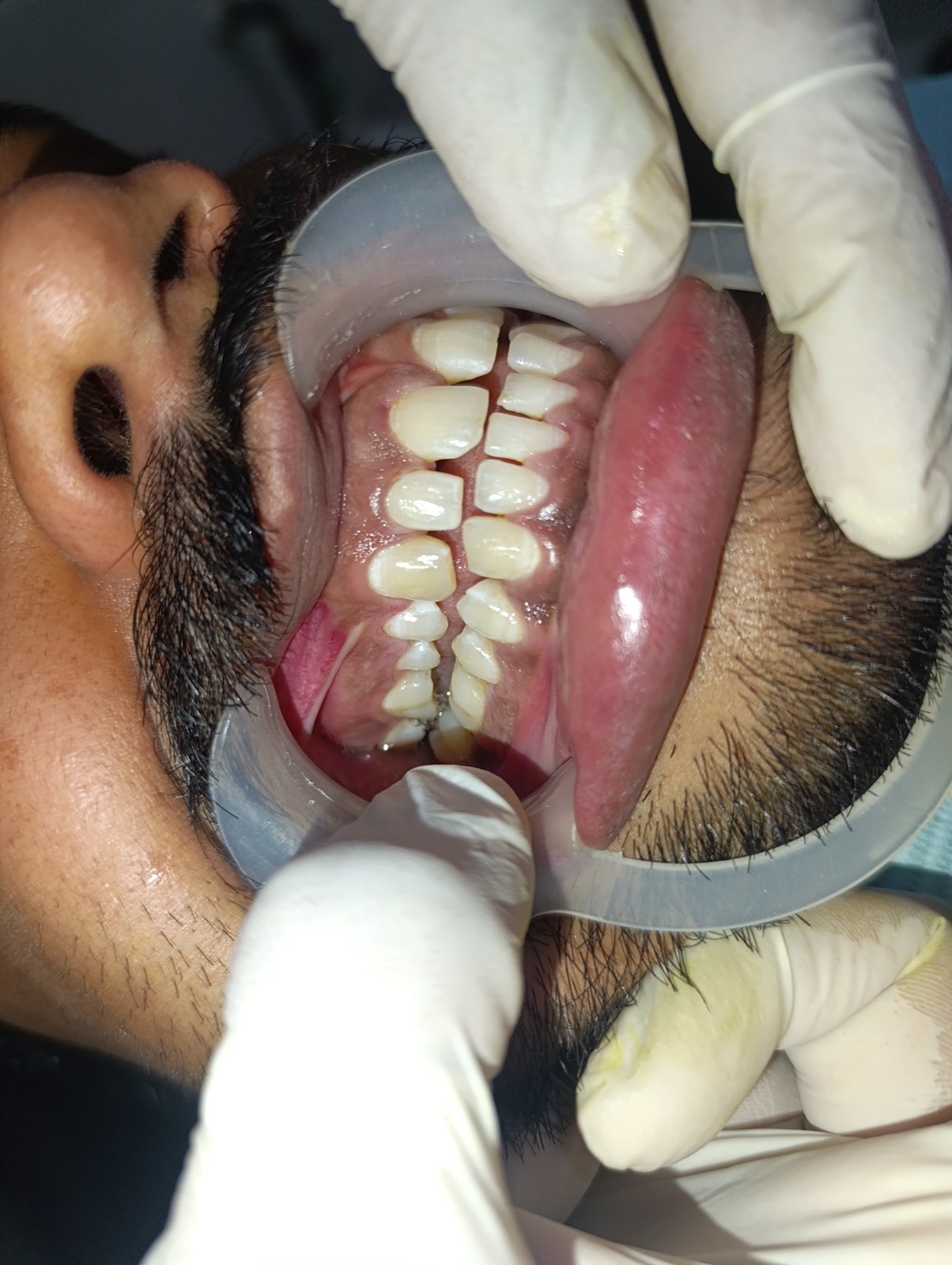 Mr. Irfan — scaling and polishing case