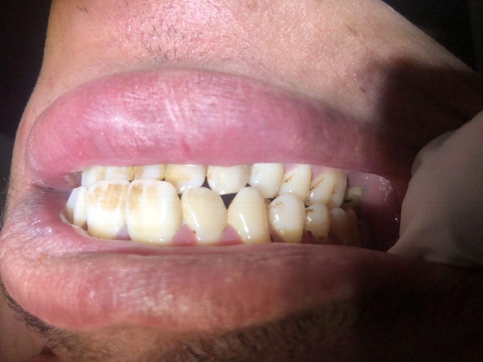 Day-one occlusal view of Mr. Salman Khan — light film of plaque, no calculus, healthy tissue