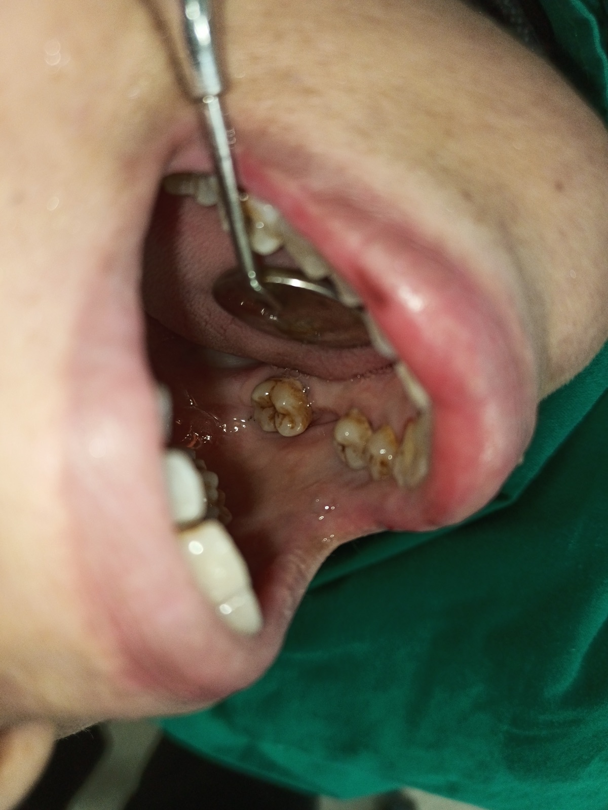 Day-one frontal view of Ms. Sameena — yellow discolouration with visible cervical exposure from years of brushing technique