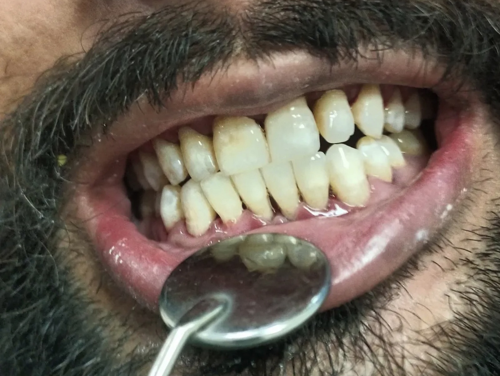 Day-one lateral view of Mr. Subhan — dense calculus and inflamed gum margins consistent with early gum disease