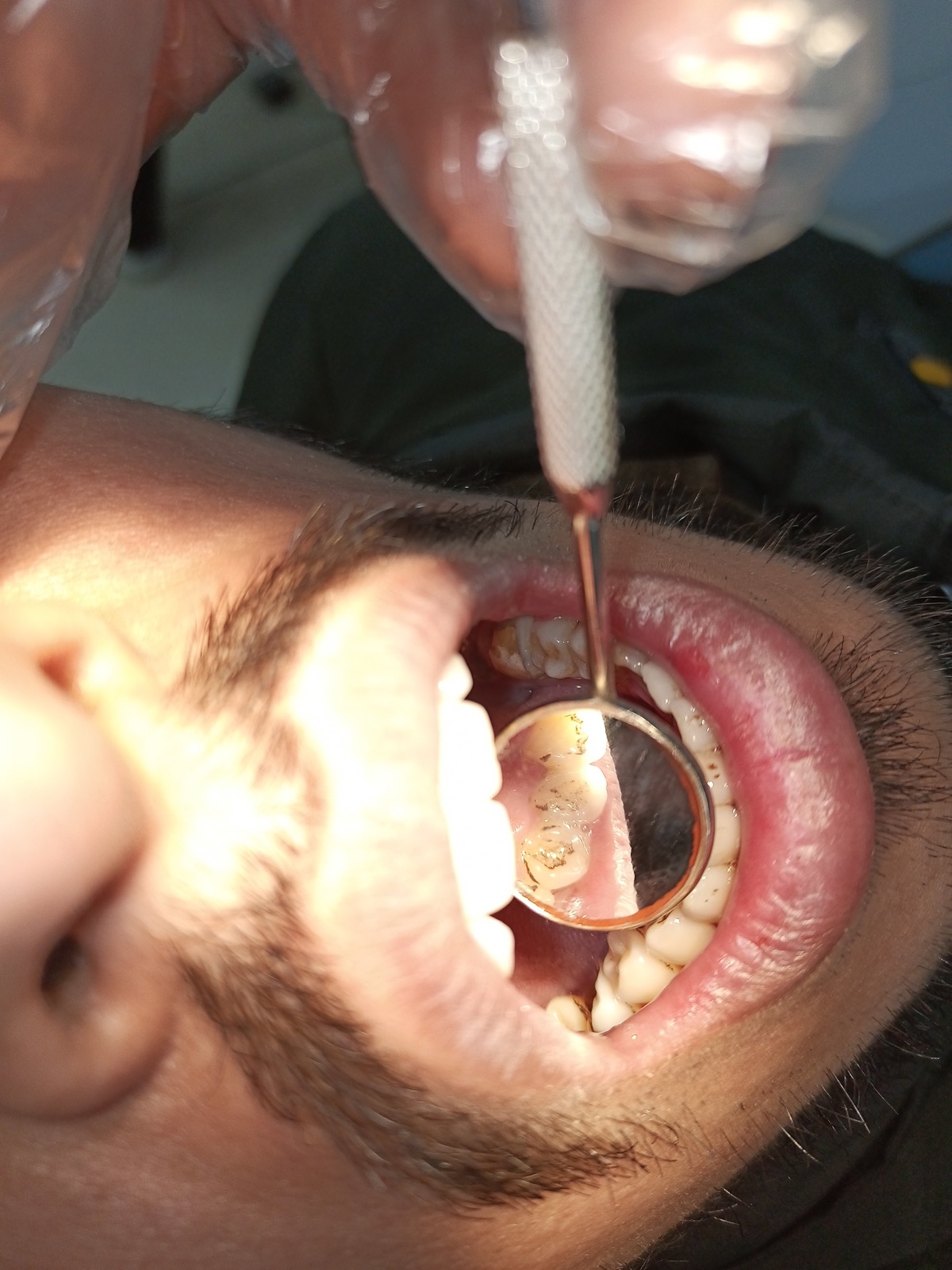 Mr. Subhan — scaling and polishing case