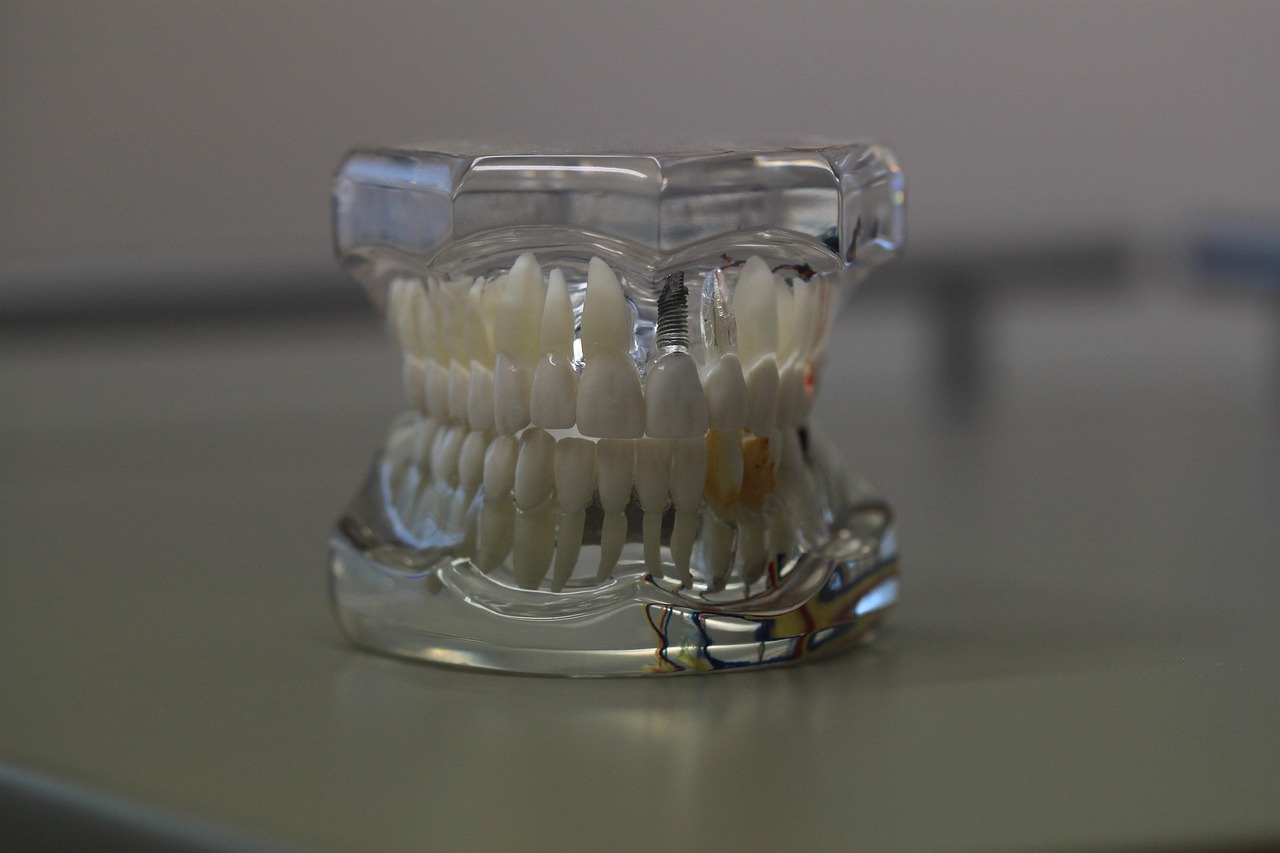 Partial acrylic with metal clasps — Odonto Lahore dentures