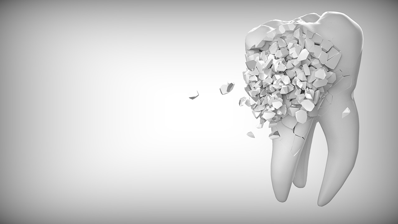 Composite (tooth-coloured) dental filling — Odonto Lahore