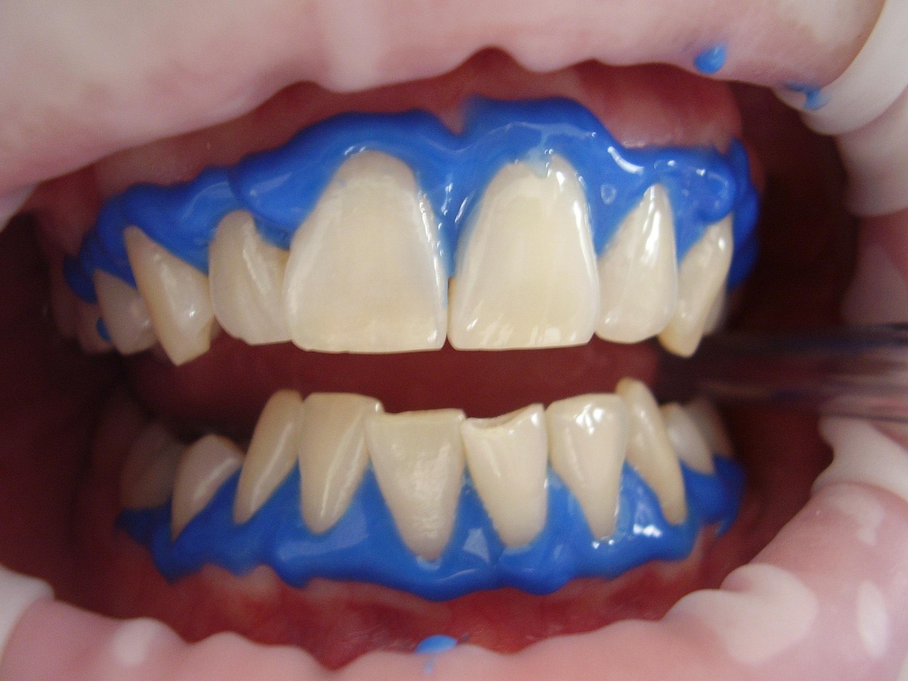 In-office laser / Zoom whitening teeth whitening — Odonto Lahore