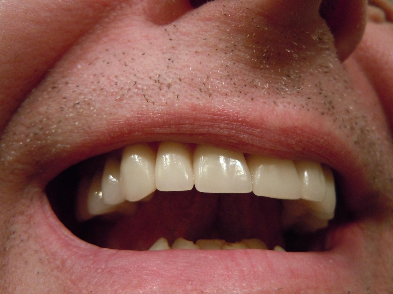 Feldspathic porcelain dental veneers — Odonto Lahore